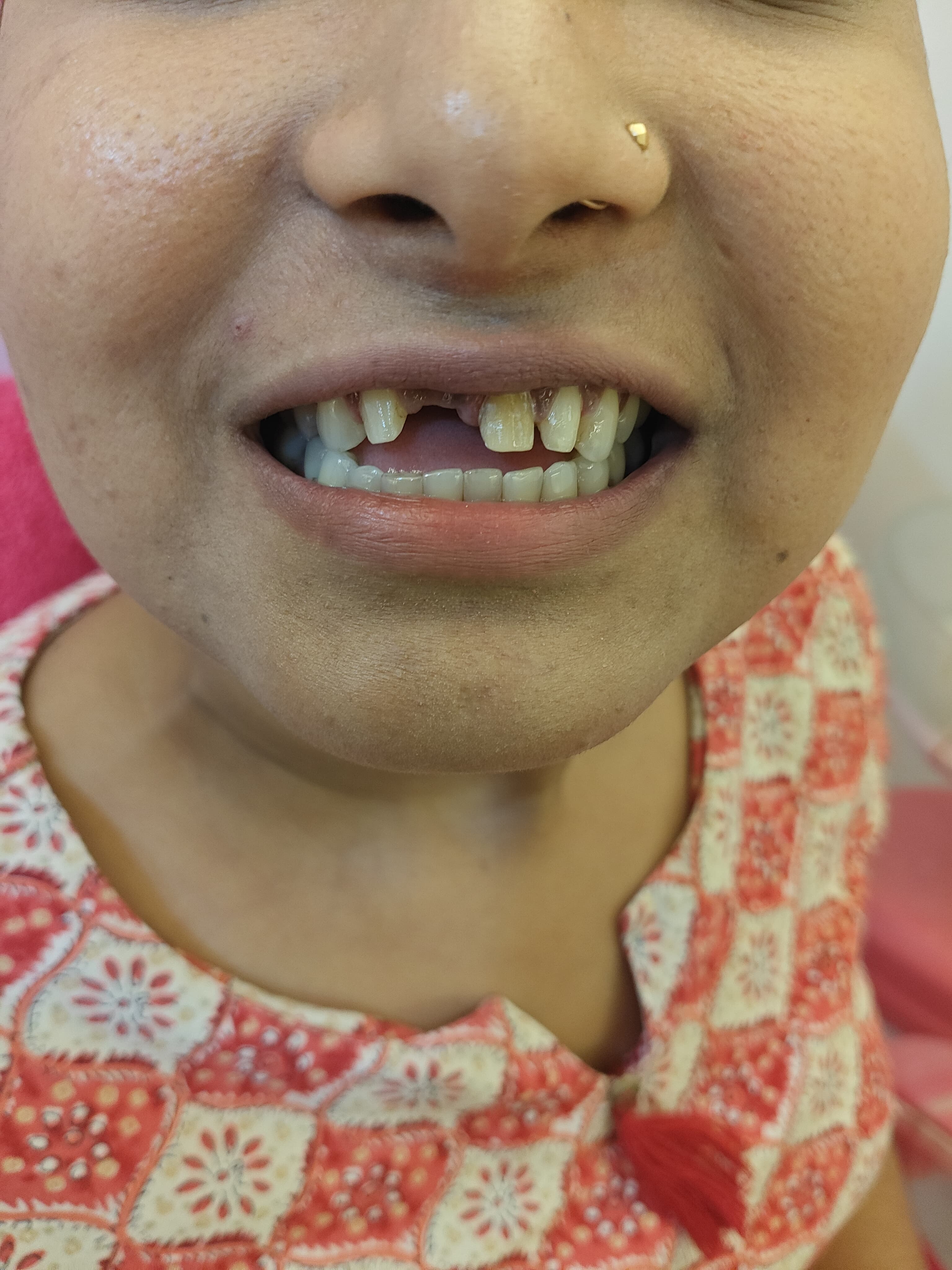 Smile Transformation Case 2